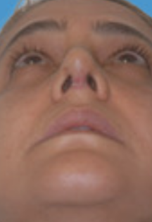 SP Septoplasty After pt.3