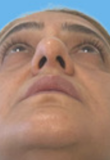 SP Septoplasty Before pt.3