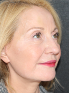 TT After Face and Neck Lift, Bleph and Fat Transfer