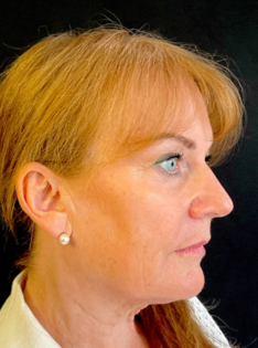 KY Before Deep Plane Face and Neck Lift, Brow Lift, Bleph & Fat Transfer