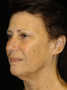 SC Before Face and Neck Lift