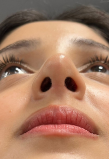 MA Septoplasty After pt.1