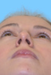 SP Septoplasty Before pt.2