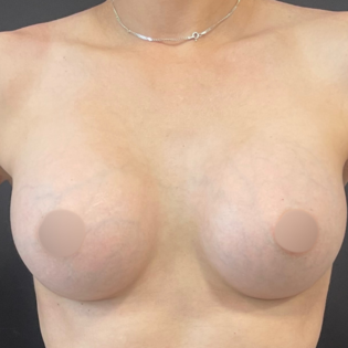 WS Breast Augmentation After
