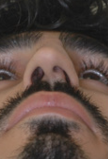 SP Septoplasty Before pt.1