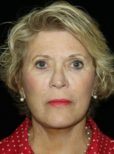 SC After Face and Neck Lift