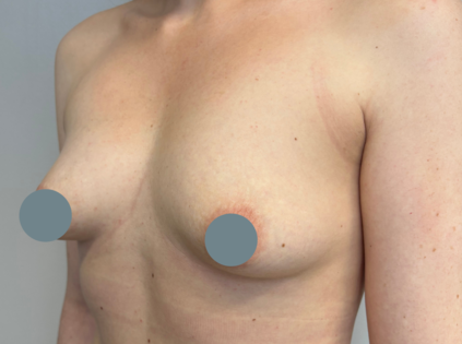 SSJ Breast Augmentation Before