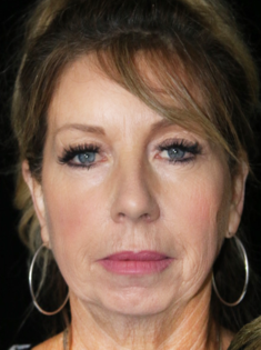 SC Before Face and Neck Lift