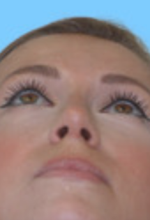 SP Septoplasty After pt.2