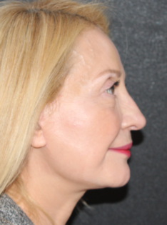 TT After Face and Neck Lift, Bleph and Fat Transfer