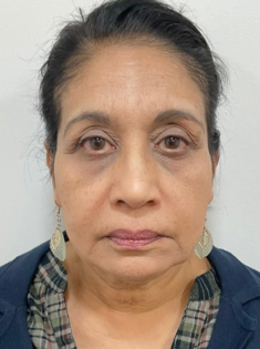 PT Before Facelift and Blepharoplasty