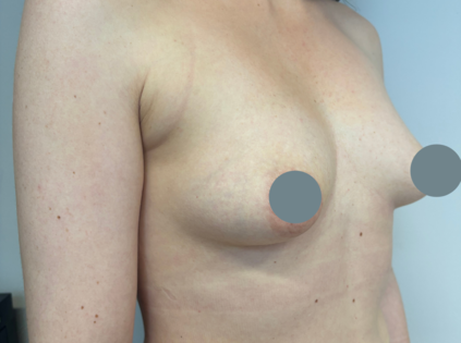 SSJ Breast Augmentation Before