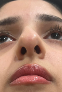 MA Septoplasty Before pt.1