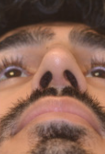 SP Septoplasty After pt.1