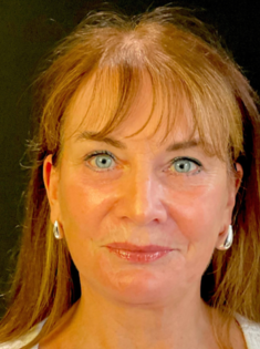 KY After Deep Plane Face and Neck Lift, Brow Lift, Bleph & Fat Transfer
