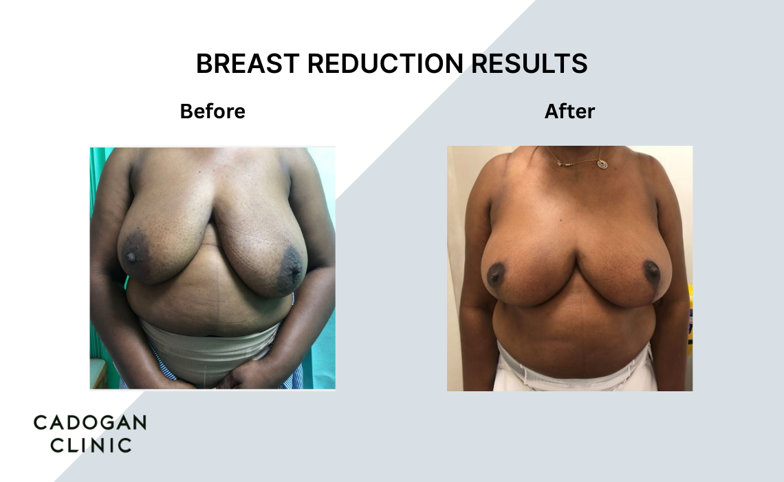 Before and after images showing a dramatic breast reduction result